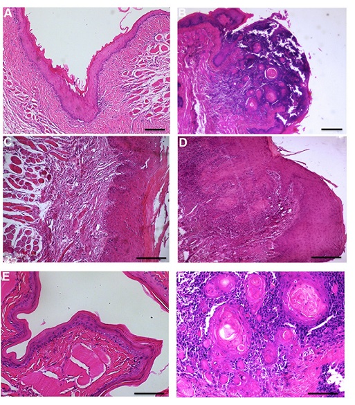 Imágenes representativas de cada estadío analizadas mediante H&E, obtenidas a 10X y 40X con microscopio de campo claro a partir de biopsias de mucosa oral de pacientes con LPMO u OSCC. El análisis y clasificación de las lesiones fueron realizadas en ciego por dos observadores independientes. Datos representativos (n=10 para cada estadío). Barra 50 um.